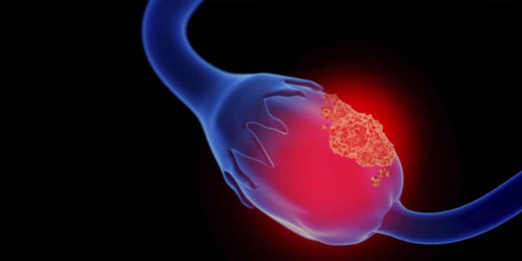 blog-5-sintomas-de-cisto-no-ovario