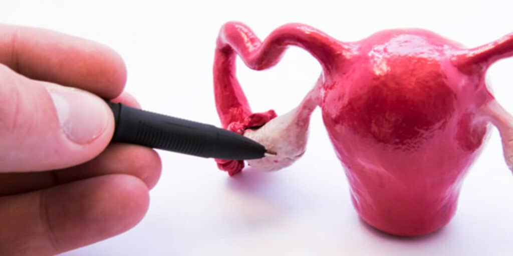 blog-fim-da-duvida-ovario-policistico