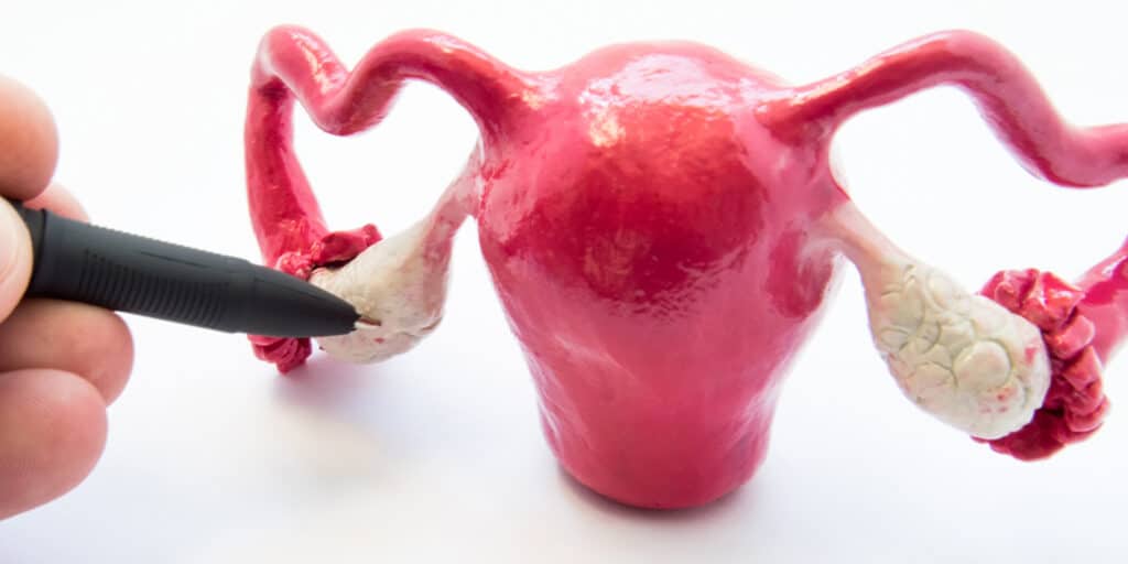 blog-cisto-hemorragico