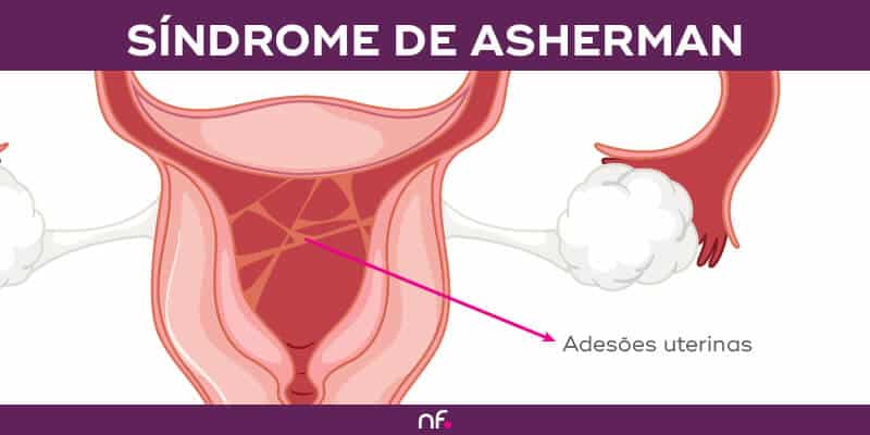 imagem síndrome de asherman representativa