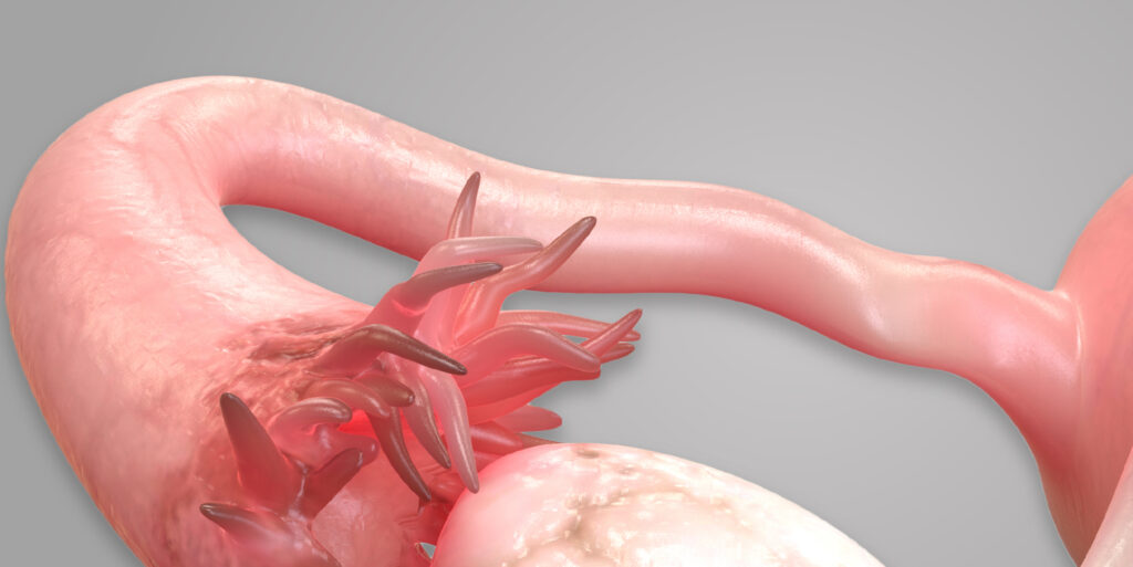 banner tubas uterinas