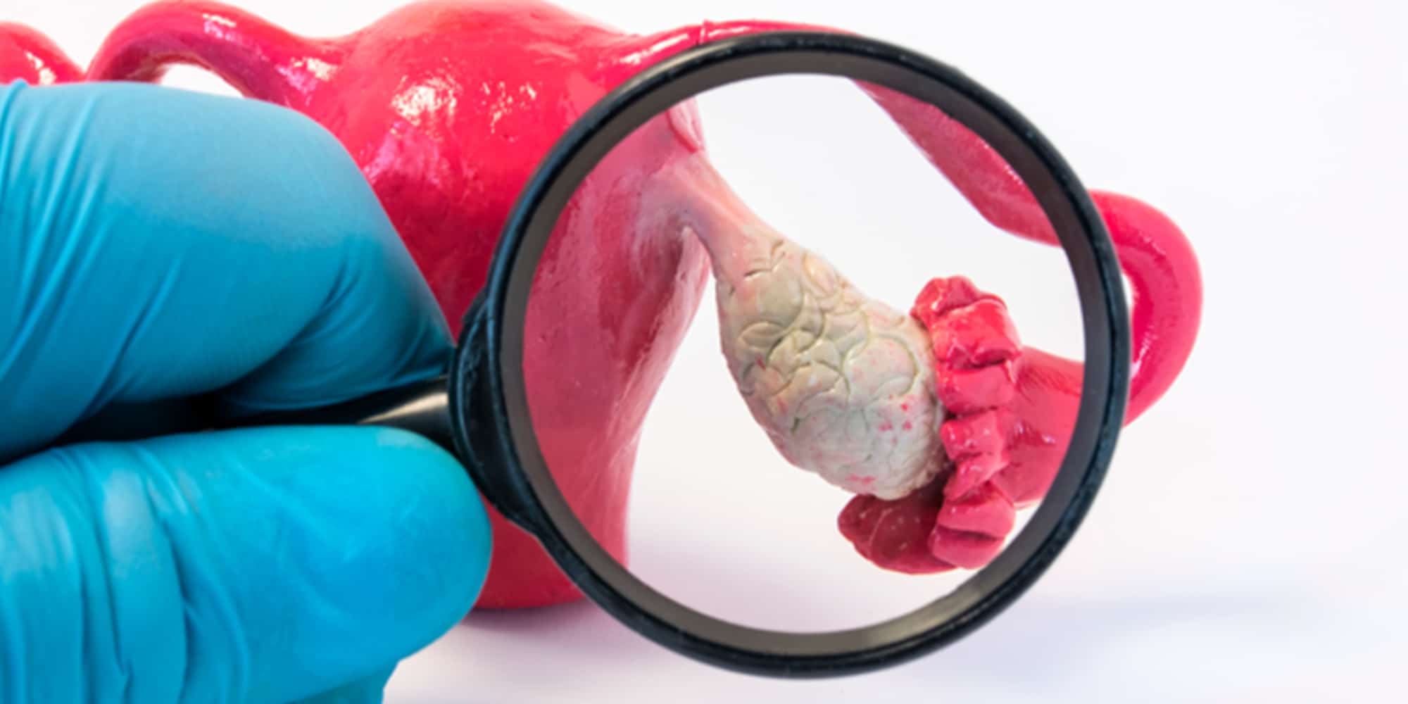 O que são ovários policísticos?