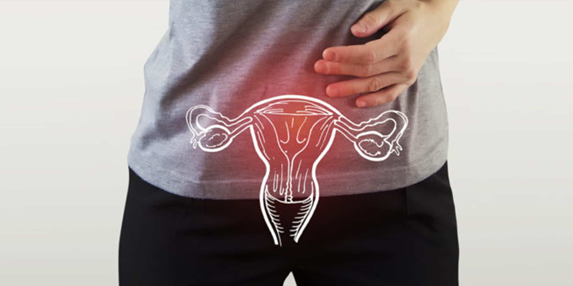 Pólipo uterino: o que é e como tratar