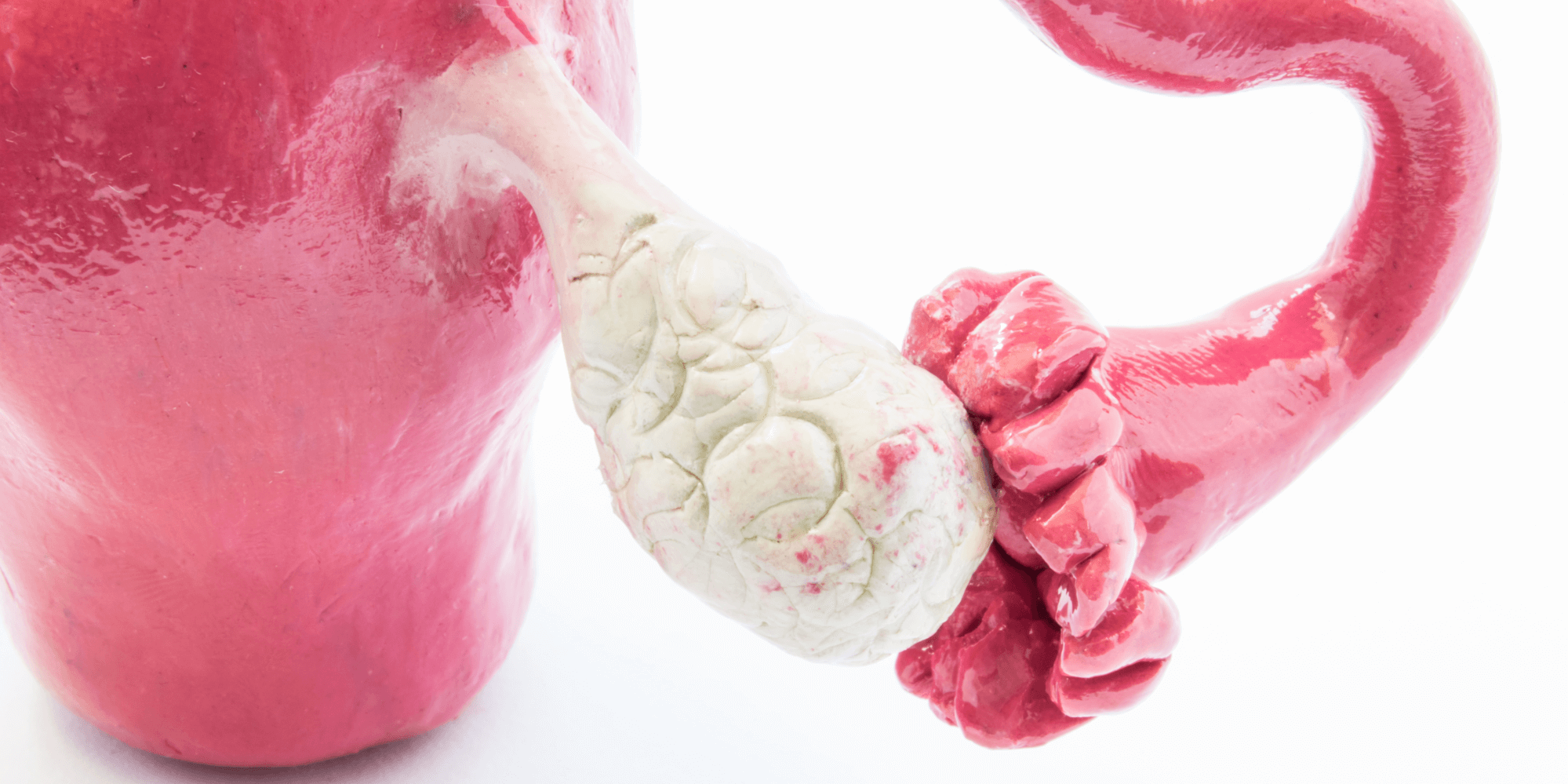 Síndrome dos Ovários Policísticos: qual a relação com gravidez?